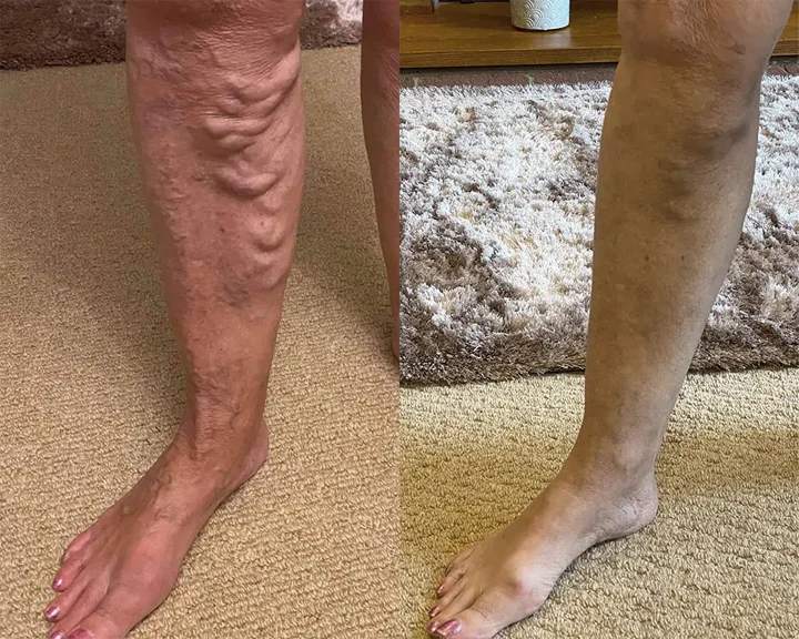 before after